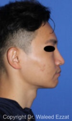 Chin Augmentation - Case 212 - After