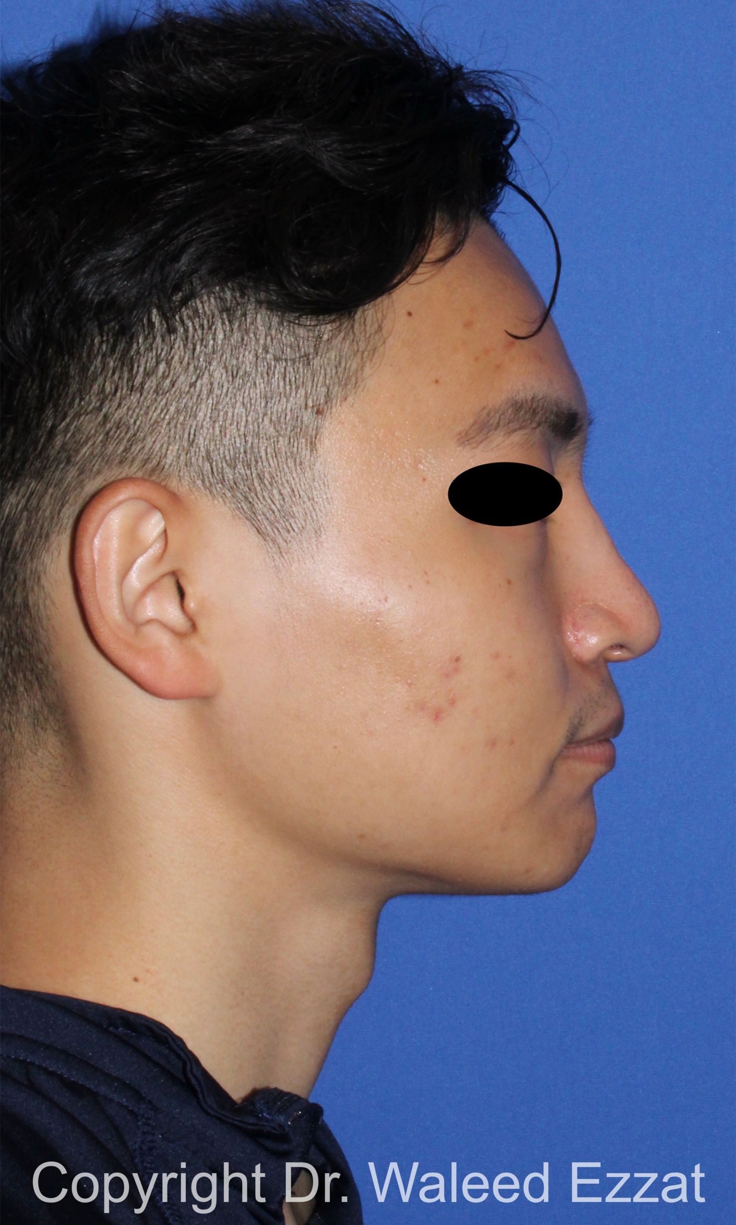 East Asian Rhinoplasty Patient Photo - Case 212 - after view