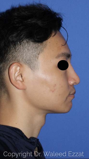 East Asian Rhinoplasty Patient Photo - Case 7491 - after view-1