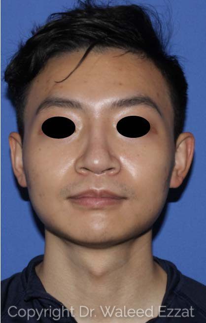 East Asian Rhinoplasty Patient Photo - Case 7491 - after view-2