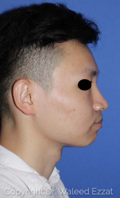 East Asian Rhinoplasty Patient Photo - Case 7491 - before view-1