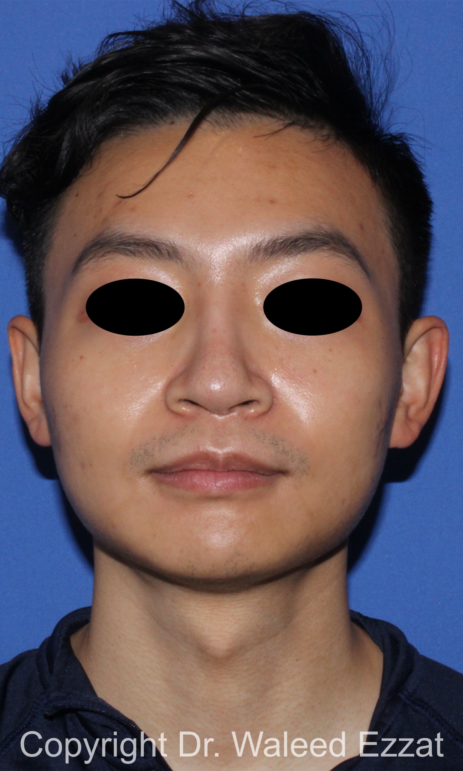 East Asian Rhinoplasty Patient Photo - Case 212 - after view-2