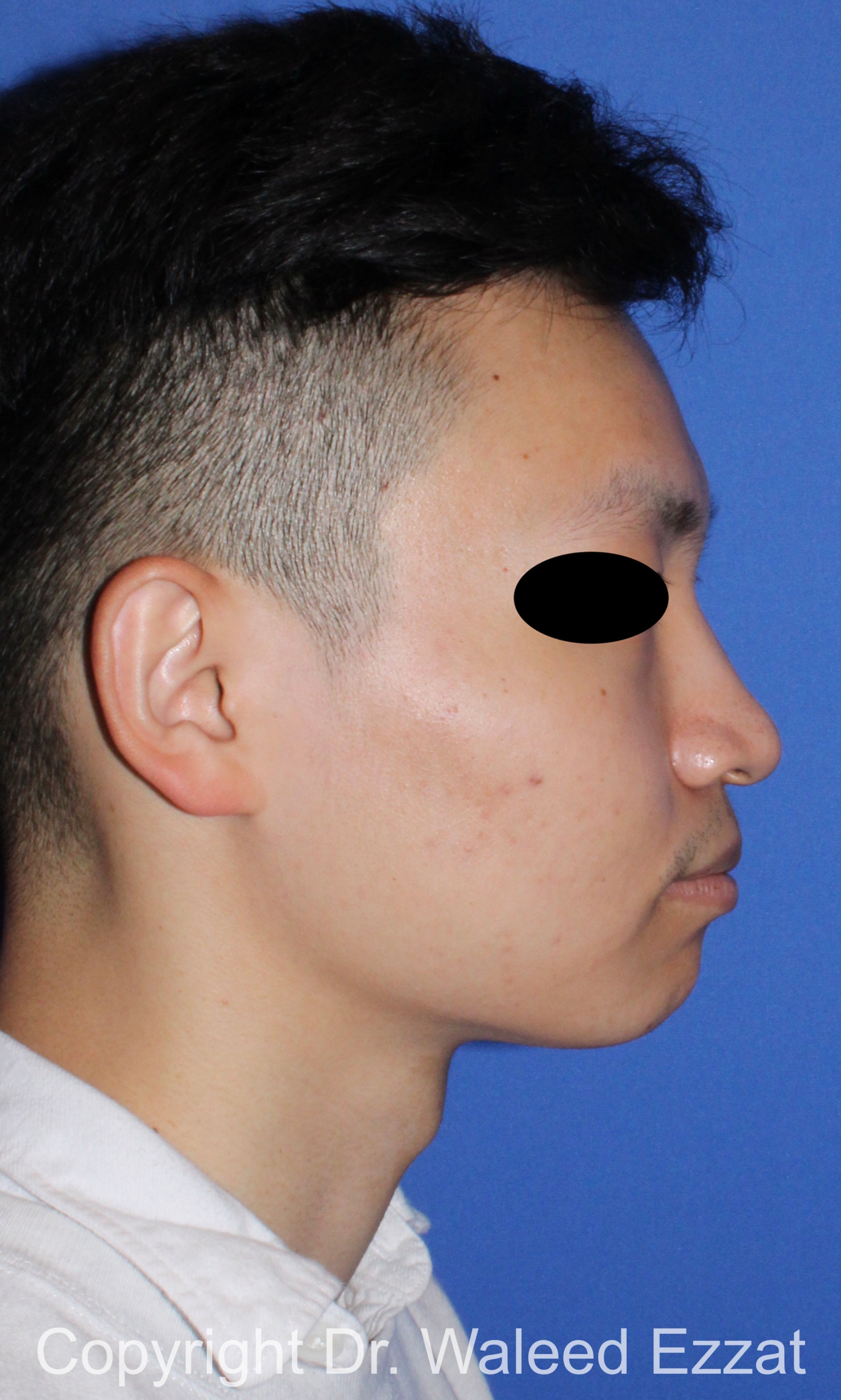 East Asian Rhinoplasty Patient Photo - Case 212 - before view-