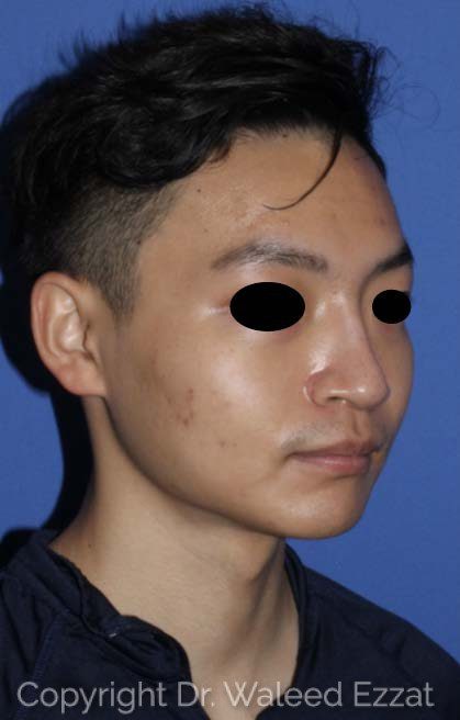 East Asian Rhinoplasty Patient Photo - Case 7491 - after view