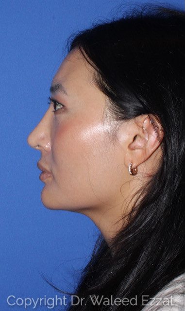 East Asian Rhinoplasty Patient Photo - Case 7502 - after view
