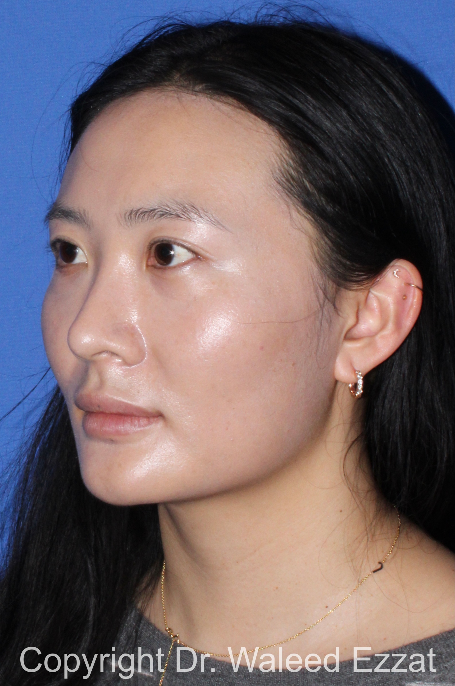 East Asian Rhinoplasty Patient Photo - Case 211 - before view-1