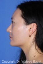 East Asian Rhinoplasty - Case 211 - Before