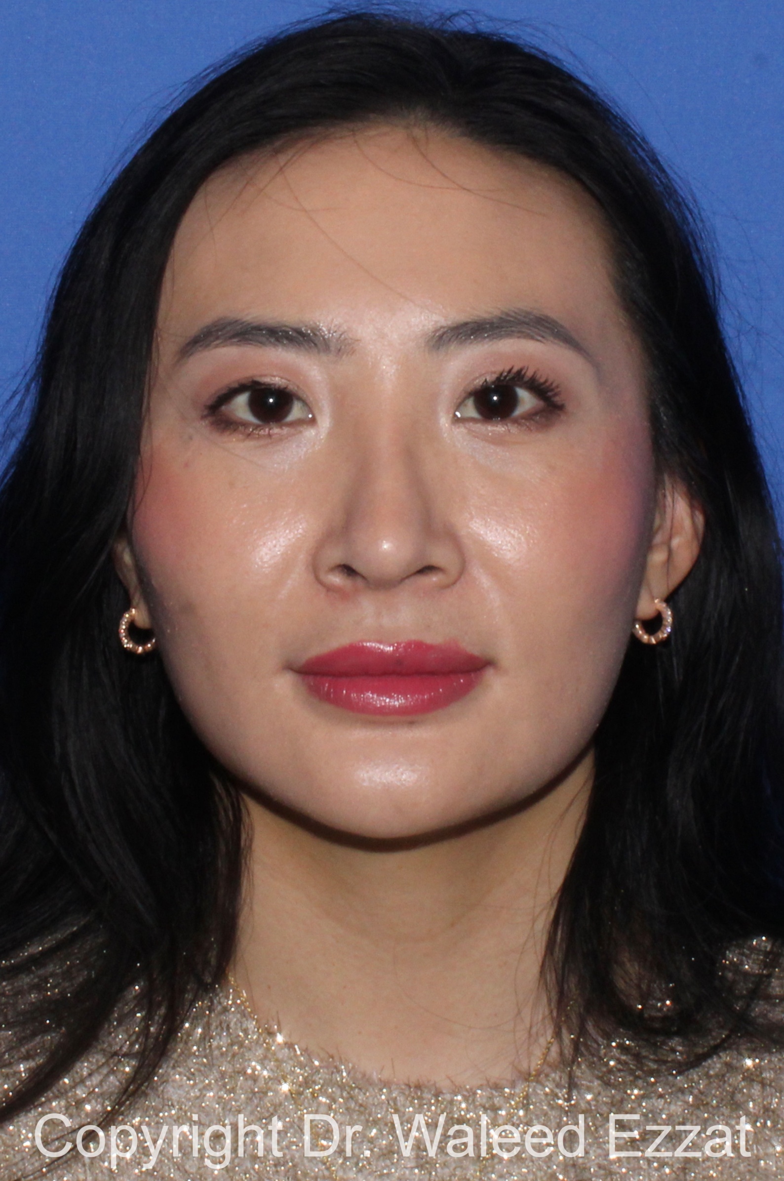 East Asian Rhinoplasty Patient Photo - Case 211 - after view-2
