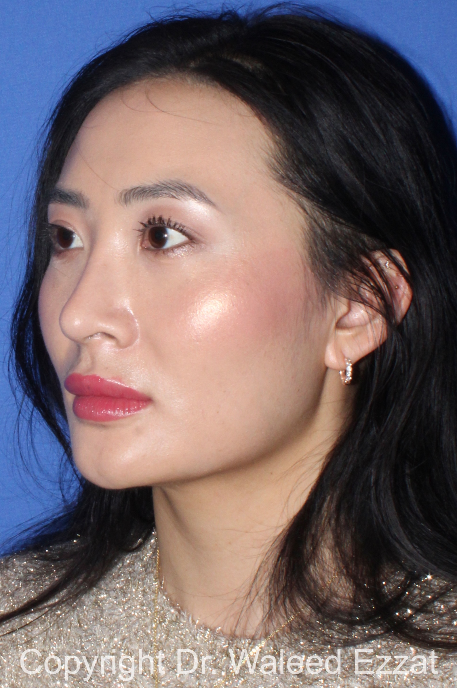 East Asian Rhinoplasty Patient Photo - Case 211 - after view-1