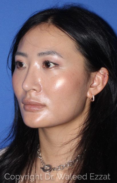 East Asian Rhinoplasty Patient Photo - Case 7502 - after view-1