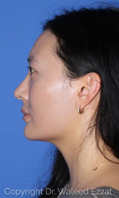 East Asian Rhinoplasty Patient Photo - Case 7502 - before view-