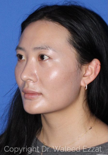 East Asian Rhinoplasty Patient Photo - Case 7502 - before view-1