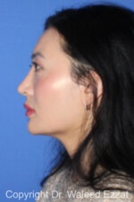 East Asian Rhinoplasty - Case 211 - After