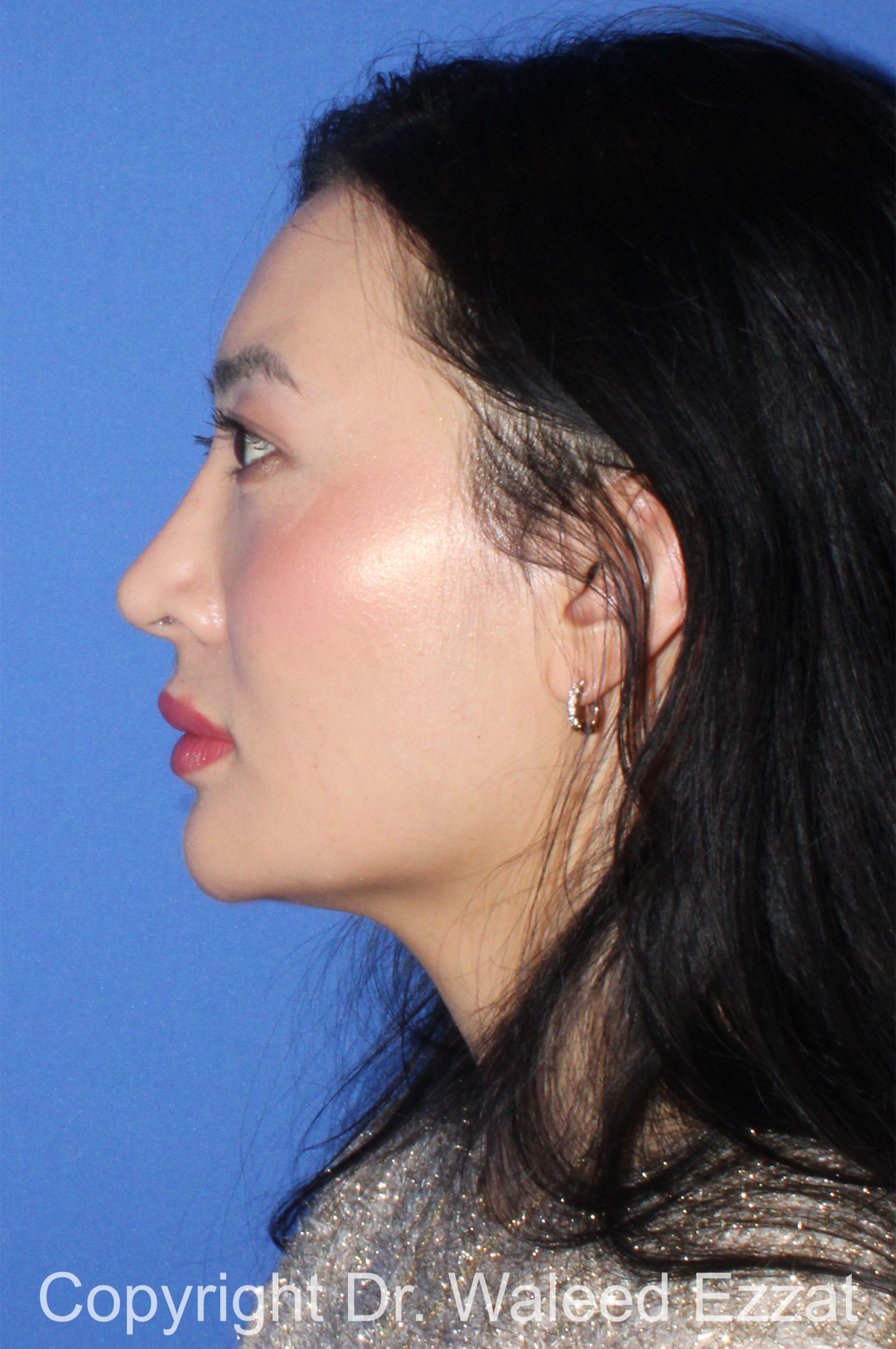 East Asian Rhinoplasty Patient Photo - Case 211 - after view