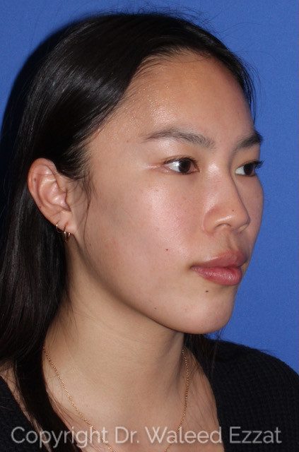 East Asian Rhinoplasty Patient Photo - Case 7508 - before view-2