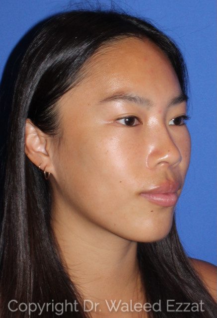 East Asian Rhinoplasty Patient Photo - Case 7508 - after view-2