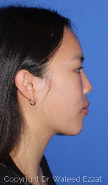 East Asian Rhinoplasty Patient Photo - Case 7508 - before view-