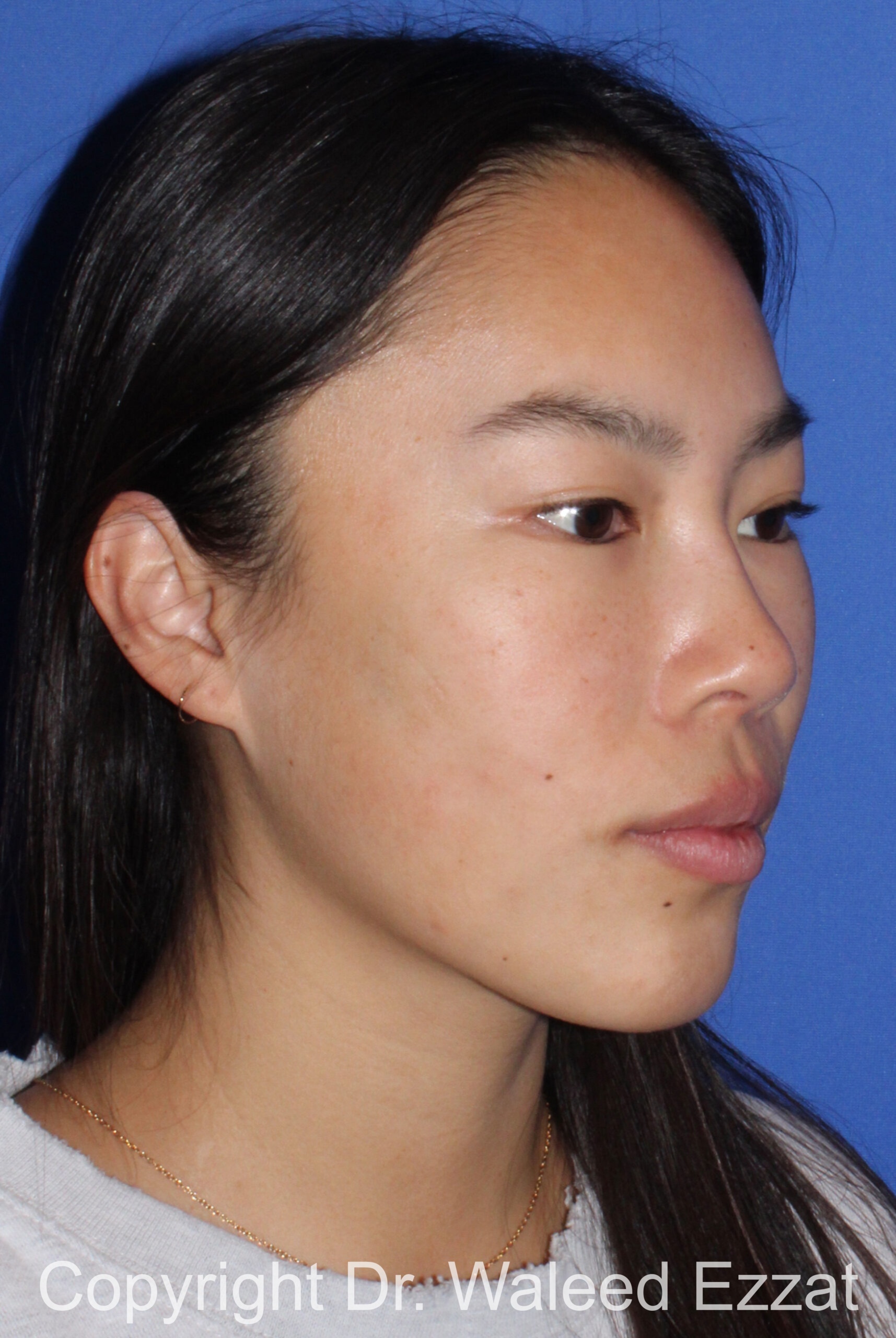 Rhinoplasty Patient Photo - Case 210 - after view-1