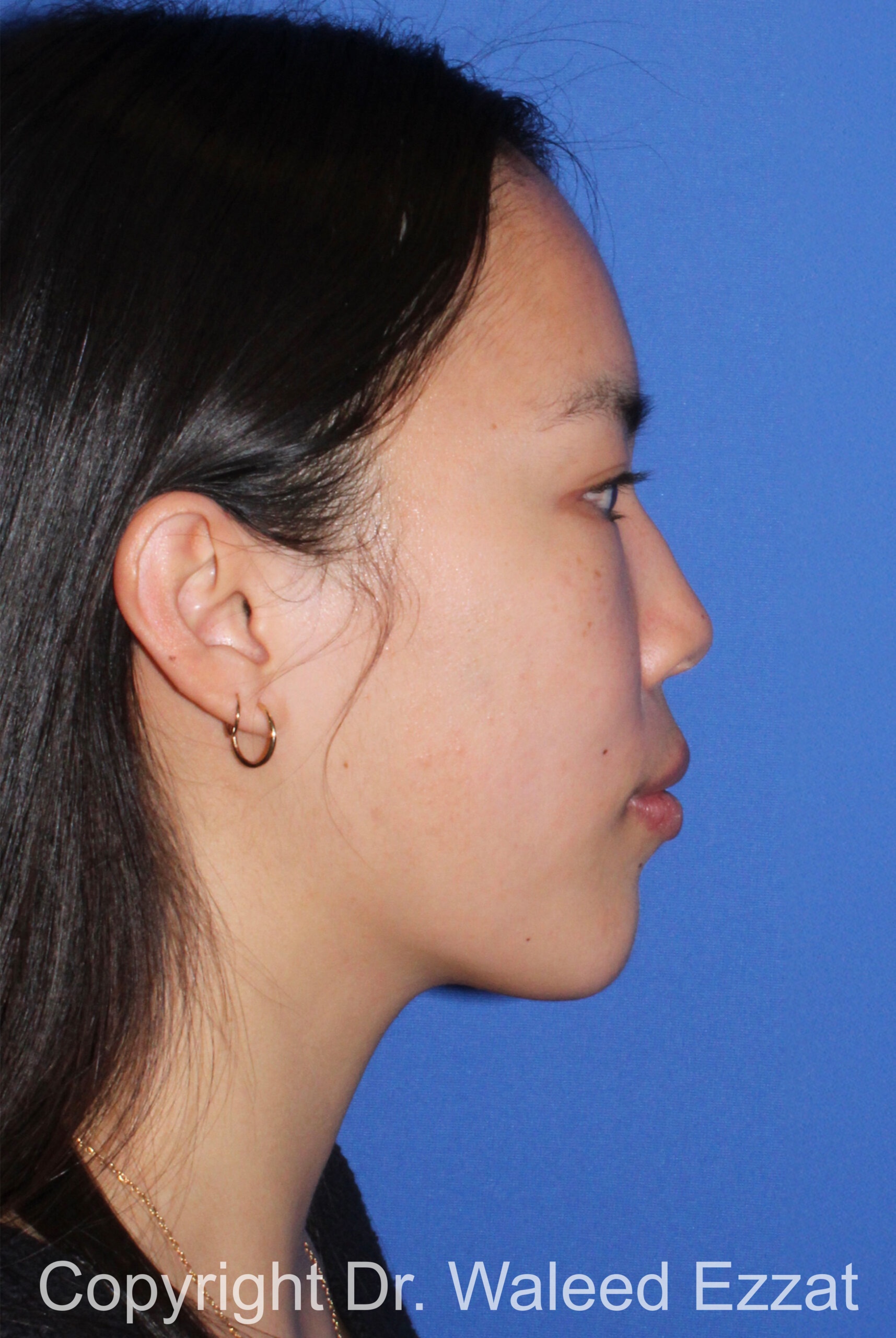 Rhinoplasty Patient Photo - Case 210 - before view-
