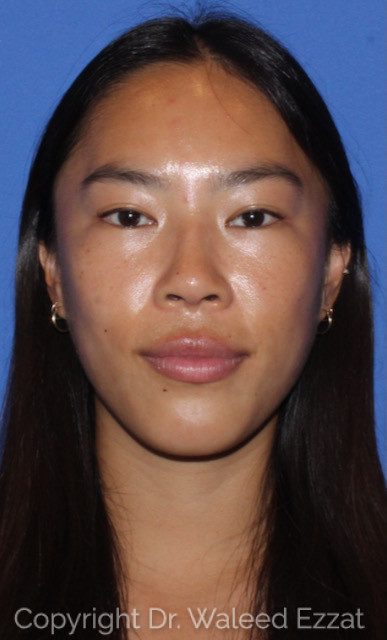 East Asian Rhinoplasty Patient Photo - Case 7508 - after view-1