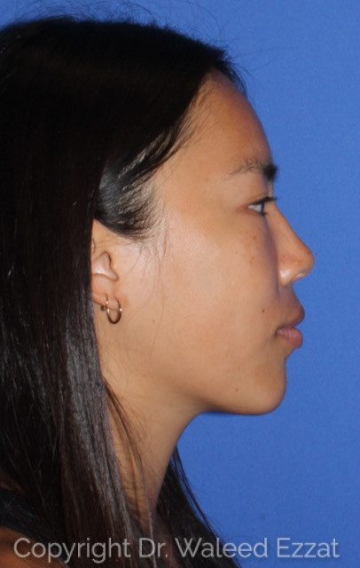 East Asian Rhinoplasty Patient Photo - Case 7508 - after view
