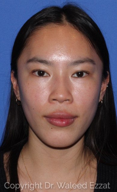 East Asian Rhinoplasty Patient Photo - Case 7508 - before view-1
