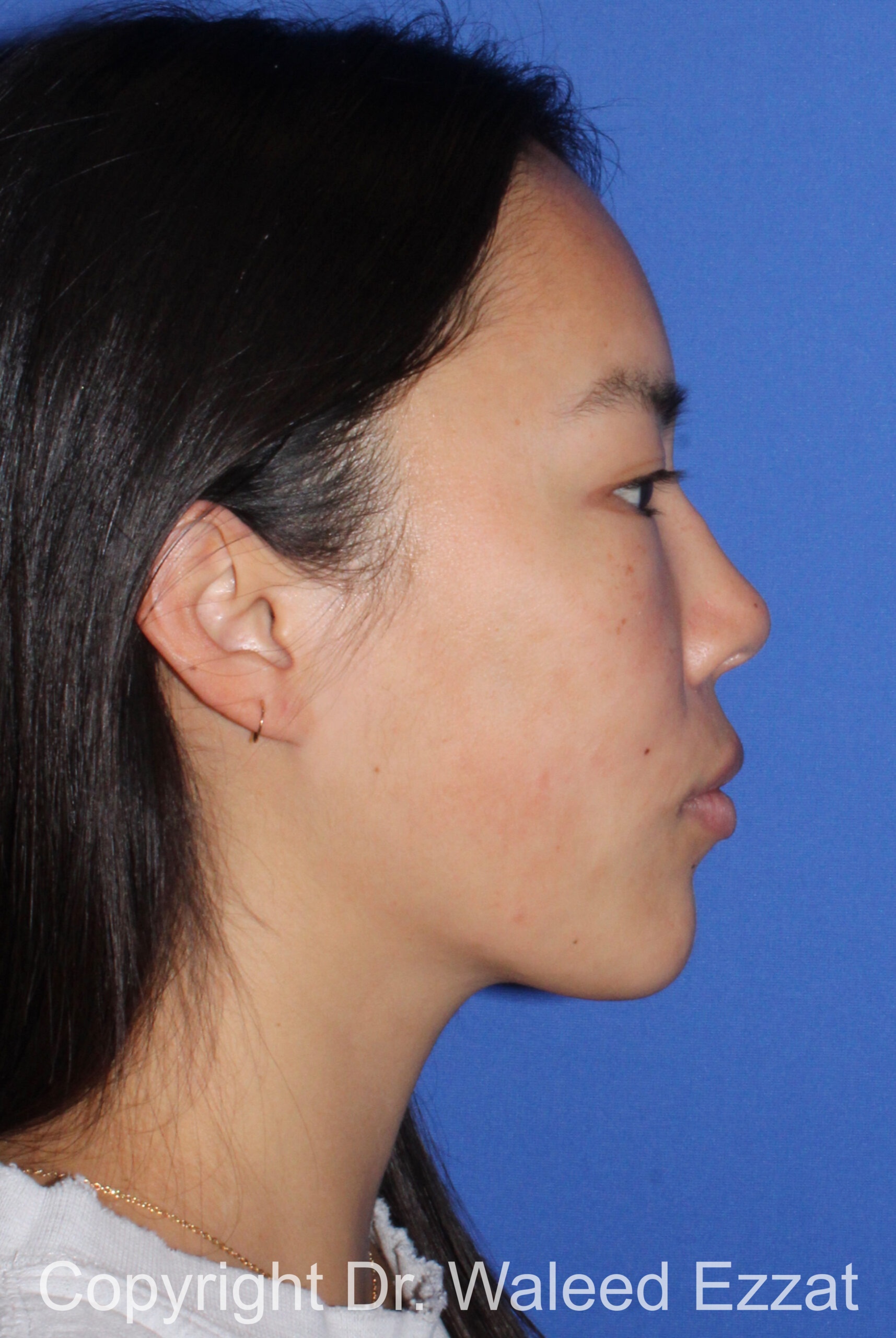 Rhinoplasty Patient Photo - Case 210 - after view