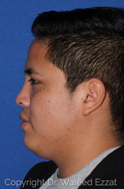Reconstructive Rhinoplasty Patient Photo - Case 7550 - after view