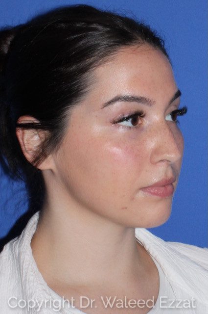 Mediterranean/Middle Eastern Rhinoplasty Patient Photo - Case 7557 - before view-