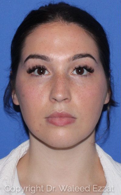 Mediterranean/Middle Eastern Rhinoplasty Patient Photo - Case 7557 - before view-2