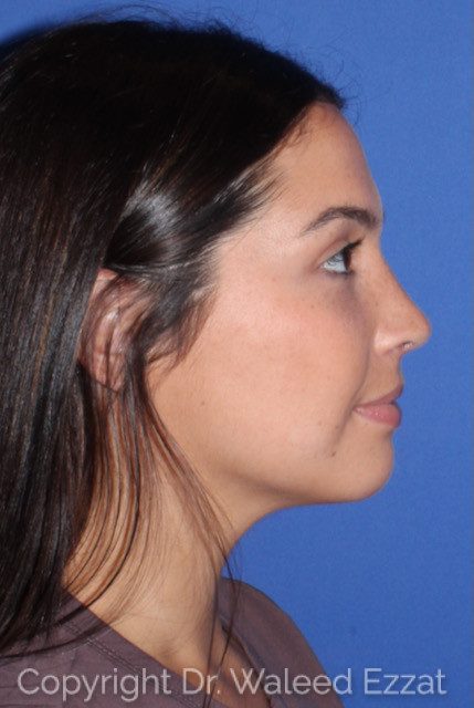 Mediterranean/Middle Eastern Rhinoplasty Patient Photo - Case 7557 - after view-1