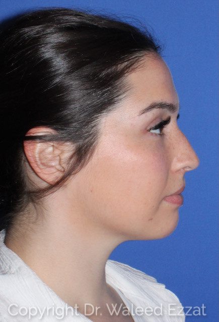 Mediterranean/Middle Eastern Rhinoplasty Patient Photo - Case 7557 - before view-1