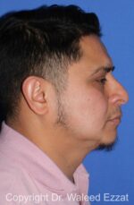 Buccal Fat Excision - Case 23 - After