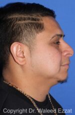 Buccal Fat Excision - Case 23 - Before