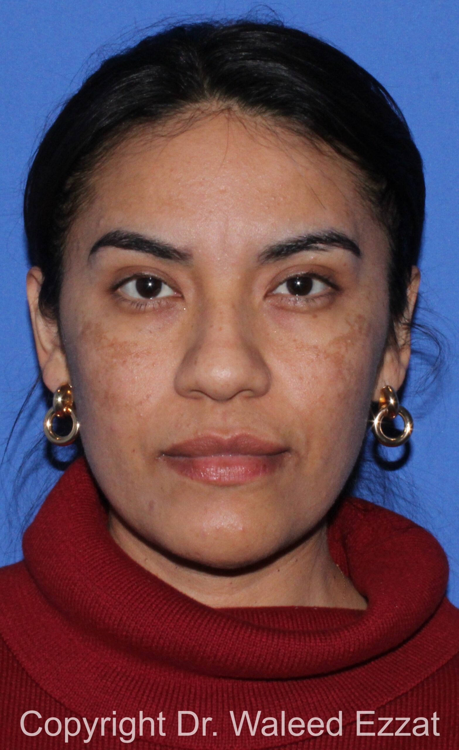 Hispanic/South American Rhinoplasty Patient Photo - Case 21 - before view-2