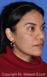 Blepharoplasty - Case 21 - Before