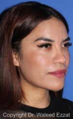 Blepharoplasty - Case 21 - After