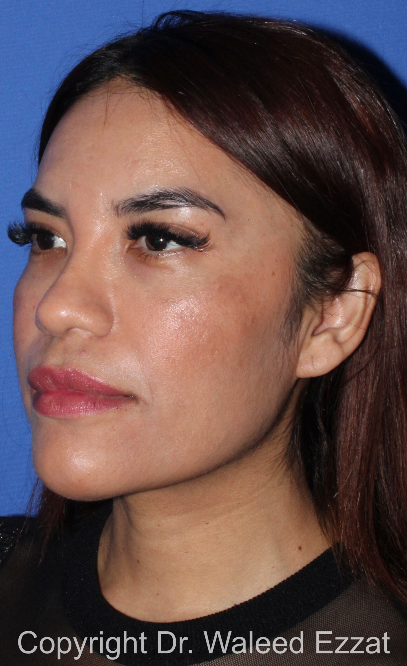 Hispanic/South American Rhinoplasty Patient Photo - Case 21 - after view-1