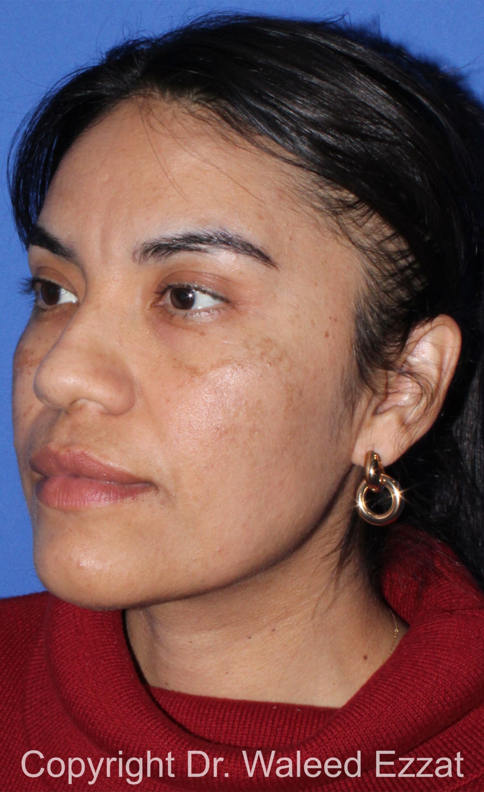 Hispanic/South American Rhinoplasty Patient Photo - Case 21 - before view-1