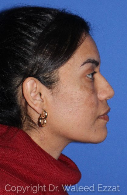 Hispanic/South American Rhinoplasty Patient Photo - Case 7748 - before view-1