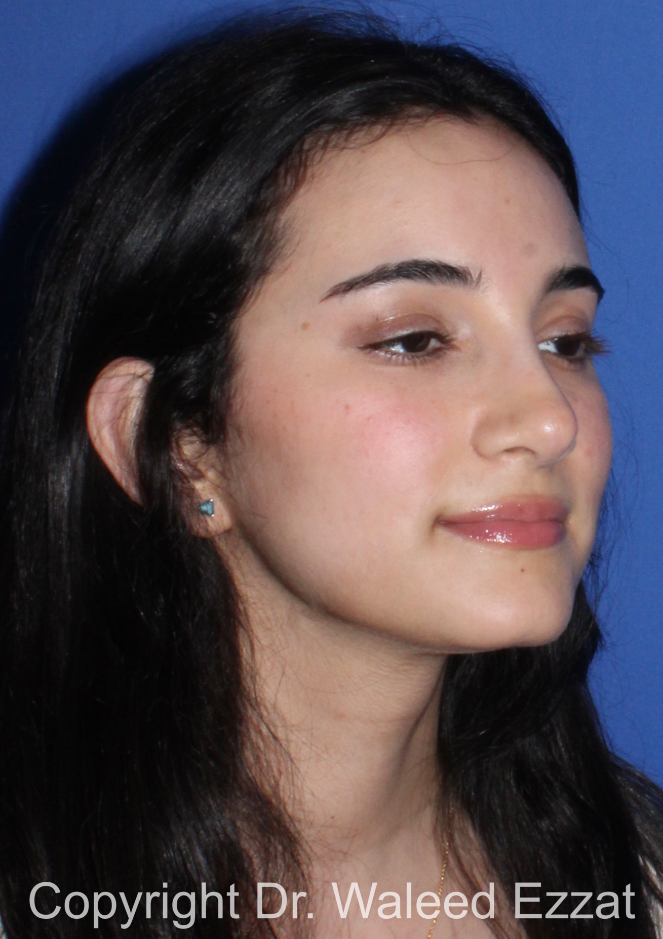 Rhinoplasty Patient Photo - Case 93 - after view-1