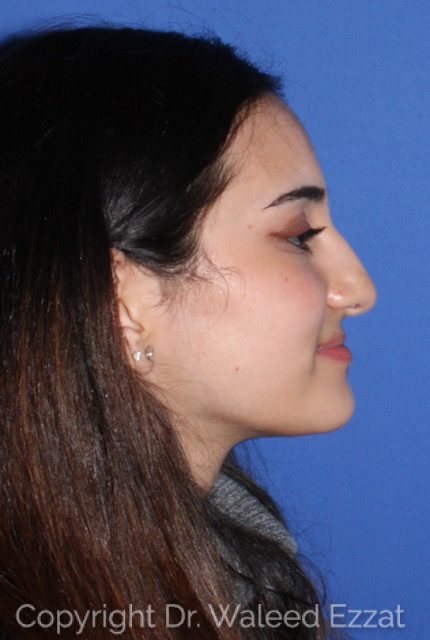 Mediterranean/Middle Eastern Rhinoplasty Patient Photo - Case 7755 - before view-