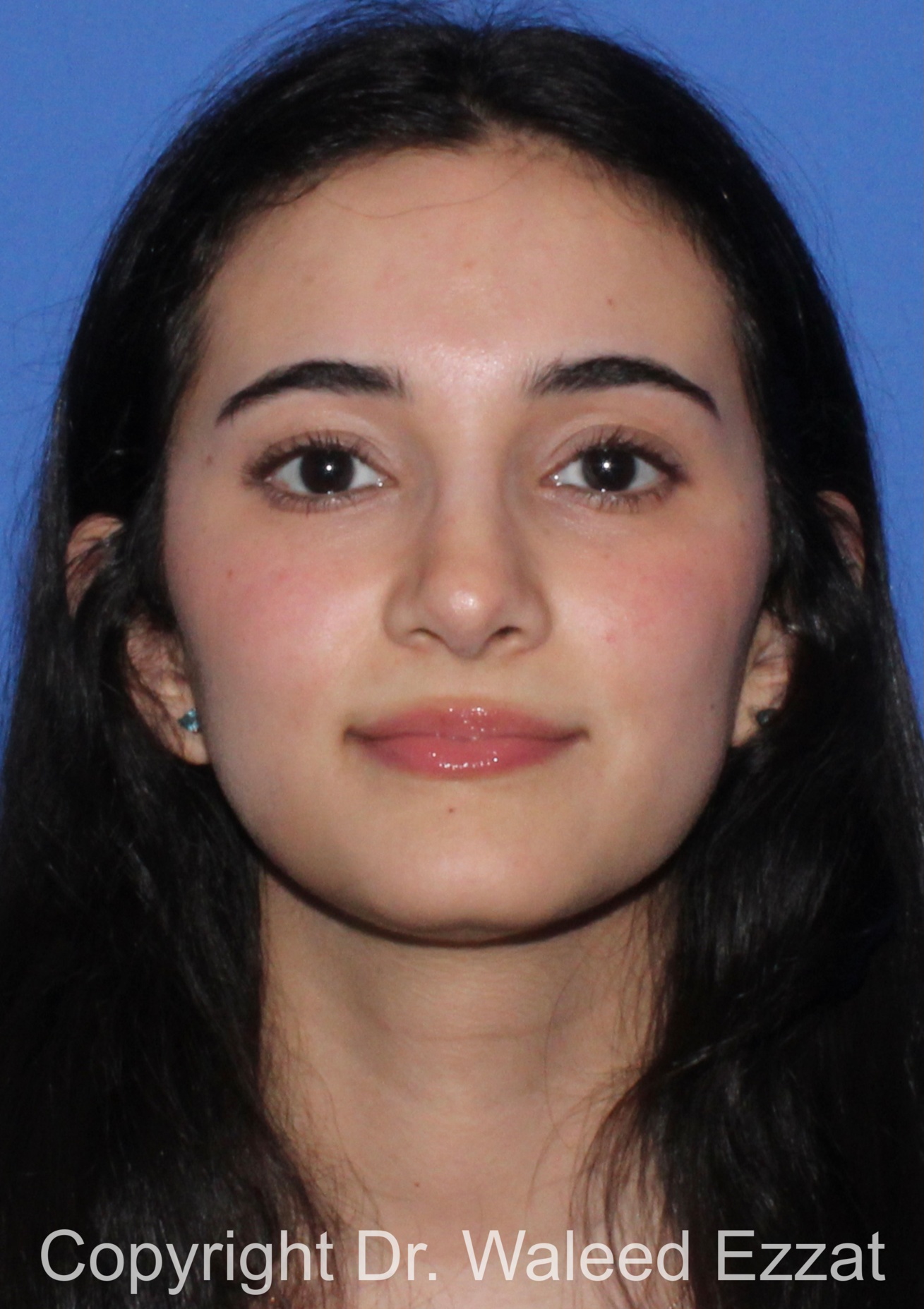 Rhinoplasty Patient Photo - Case 93 - after view-2