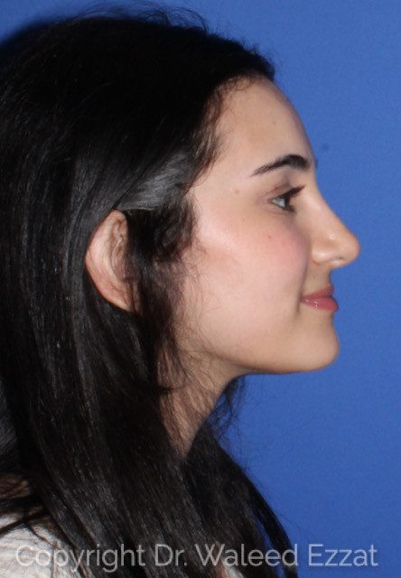 Mediterranean/Middle Eastern Rhinoplasty Patient Photo - Case 7755 - after view