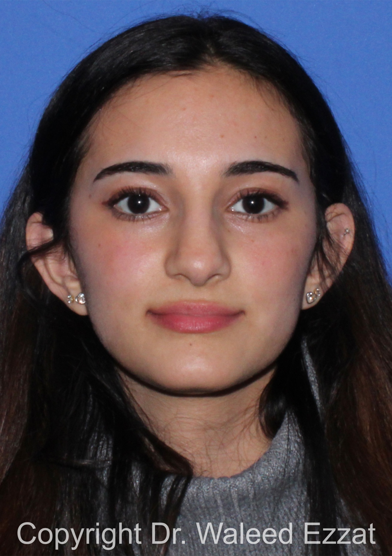 Rhinoplasty Patient Photo - Case 93 - before view-2