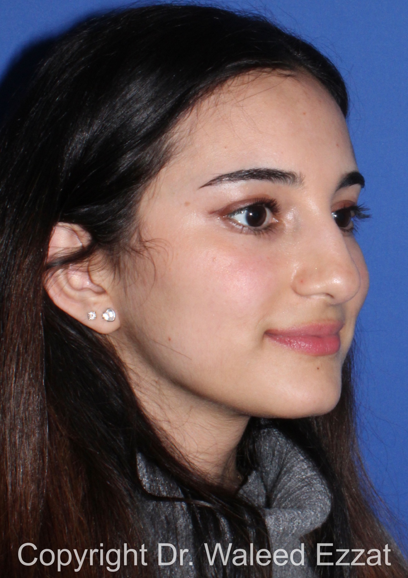 Rhinoplasty Patient Photo - Case 93 - before view-1