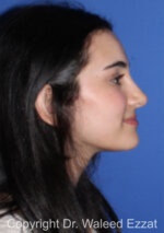 Mediterranean/Middle Eastern Rhinoplasty - Case 93 - After
