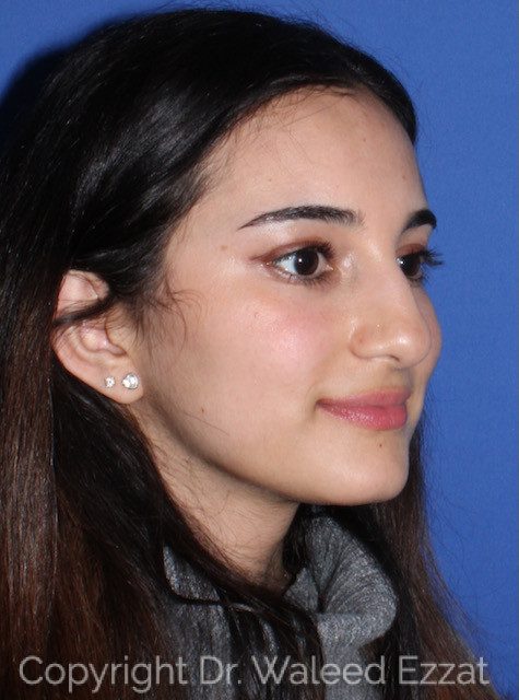 Mediterranean/Middle Eastern Rhinoplasty Patient Photo - Case 7755 - before view-1