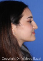 Mediterranean/Middle Eastern Rhinoplasty - Case 93 - Before