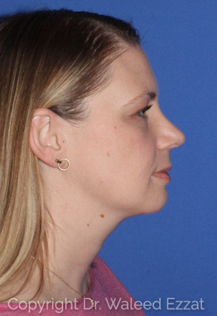 Rhinoplasty Patient Photo - Case 7763 - after view